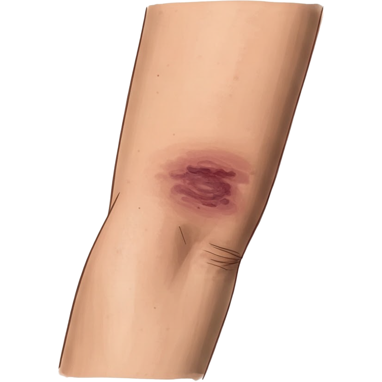 bruise แปลว่า ทำให้เกิดบาดแผล