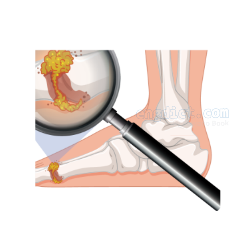 Pus (พัส) แปลว่าอะไร? ดูความหมาย ภาพประกอบ ตัวอย่างประโยค | Engdict.Com